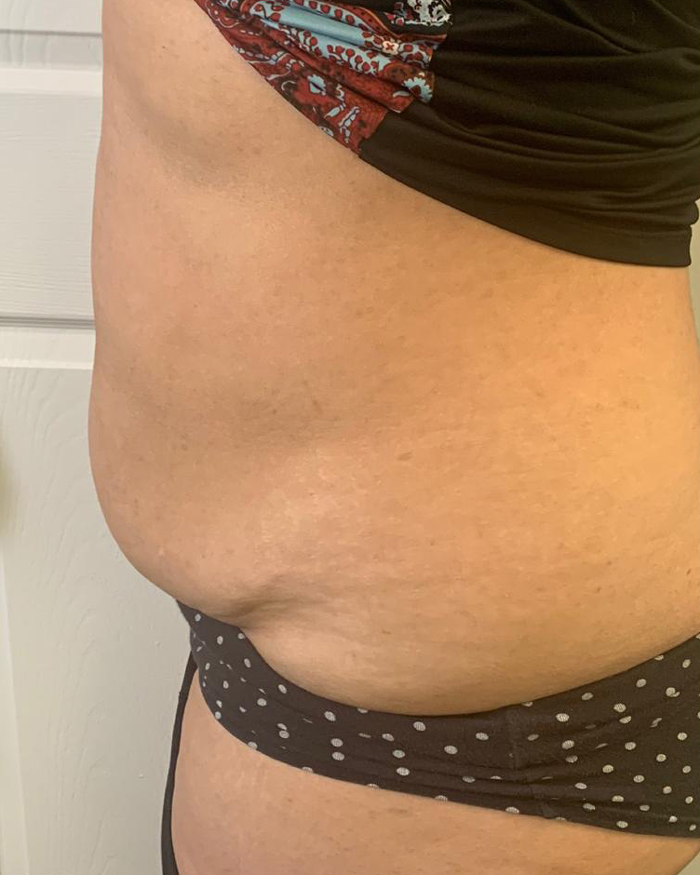 After Abdominal Contouring