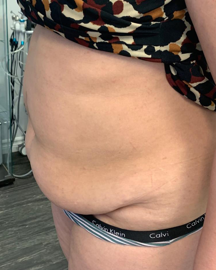 Before Abdominal Contouring