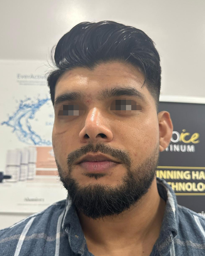 After Chemical Peel - Acne Scar Treatment
