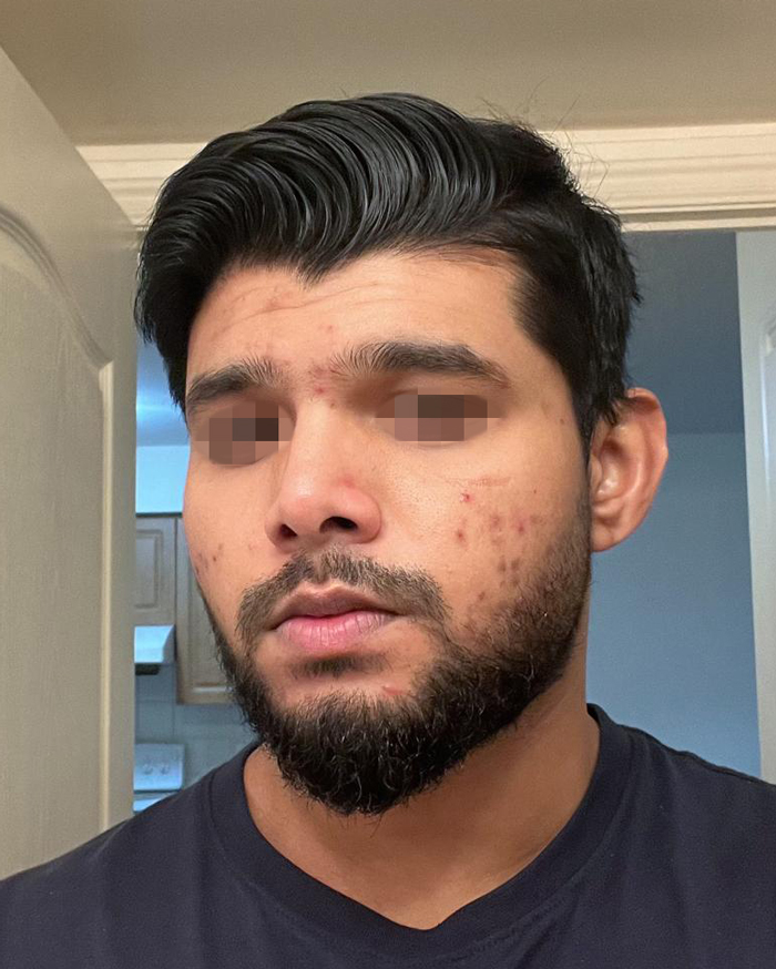 Before Chemical Peel - Acne Scar Treatment