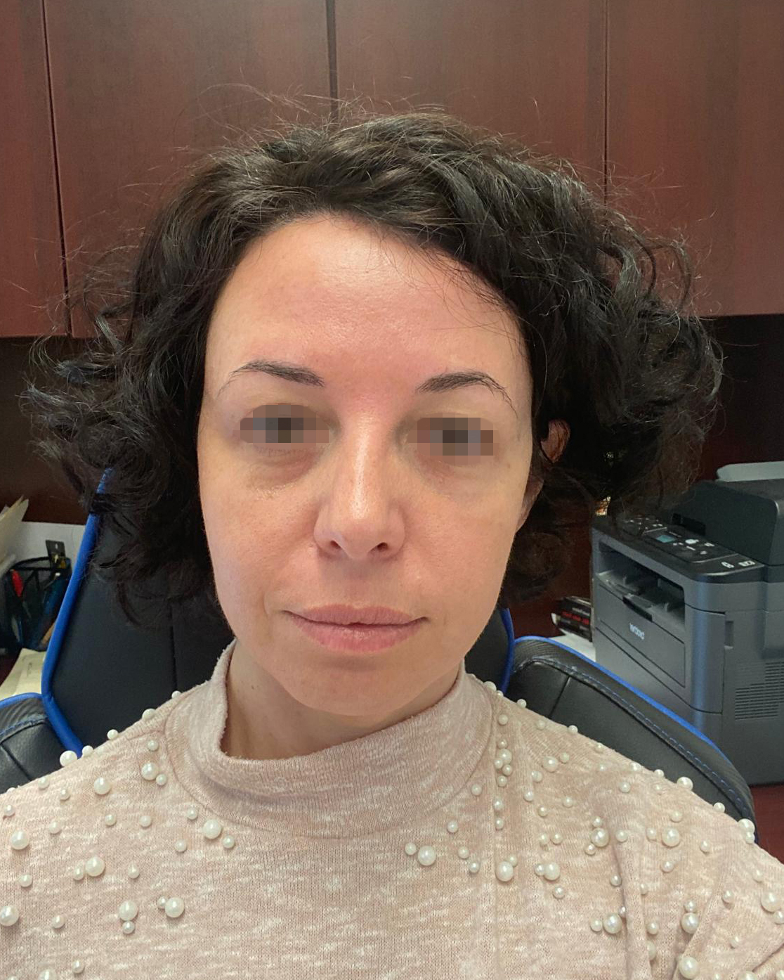 After Skin Tightening