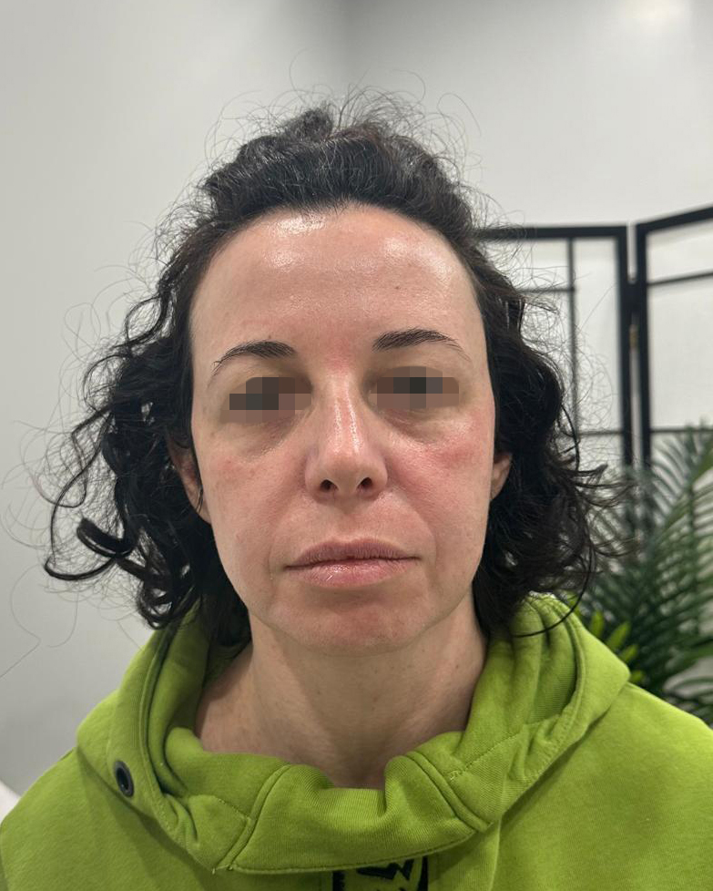 Before Skin Tightening