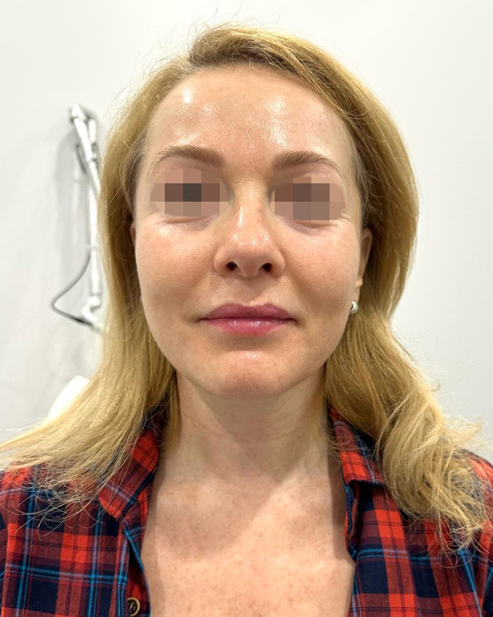 After Skin Rejuvenation Treatment