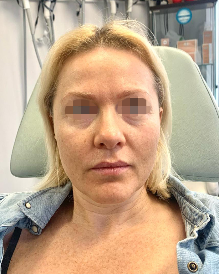 Before Skin Rejuvenation Treatment