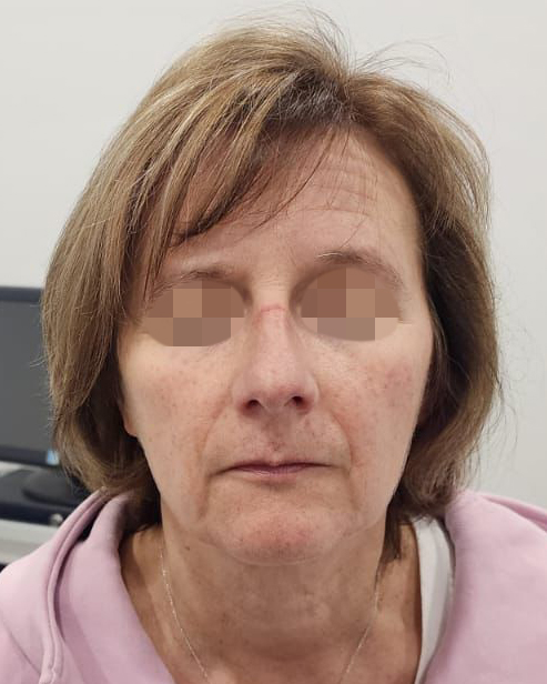 After Rosacea Treatment