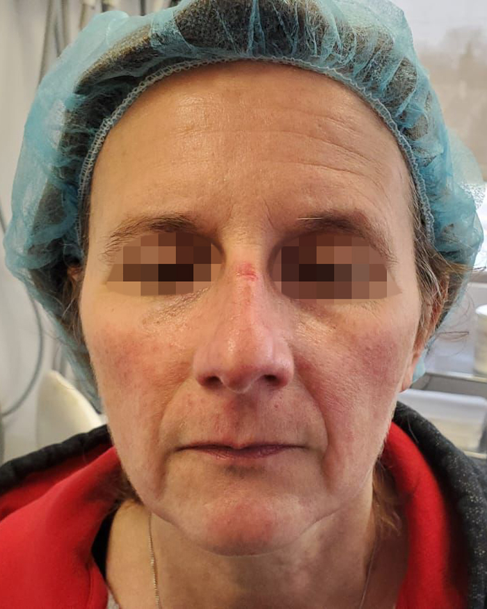 Before Rosacea Treatment