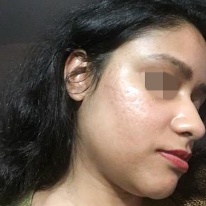 After Skin Resurfacing
