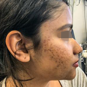 Before Skin Resurfacing