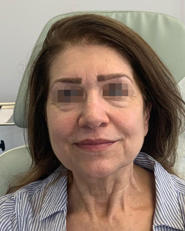 After Skin Rejuvenation Treatment