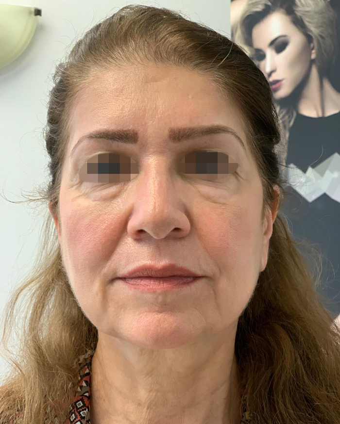 Before Skin Rejuvenation Treatment