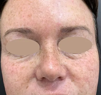 After Acne Scar Reduction