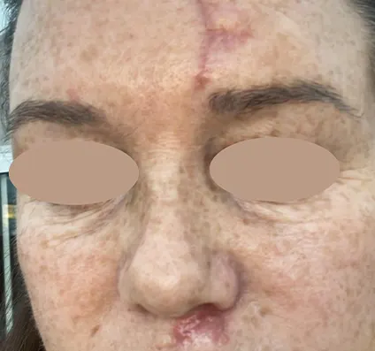 Before Acne Scar Reduction