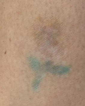 After Black Ink Tattoo Removal