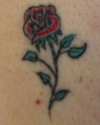 Before Black Ink Tattoo Removal