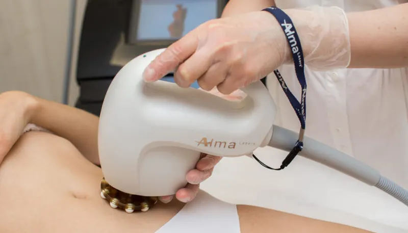 Accent V-Shape Body Contouring treatment