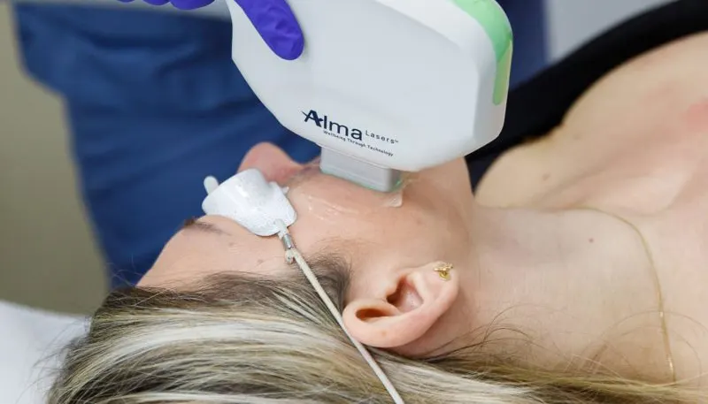 Dye-VL laser treatment