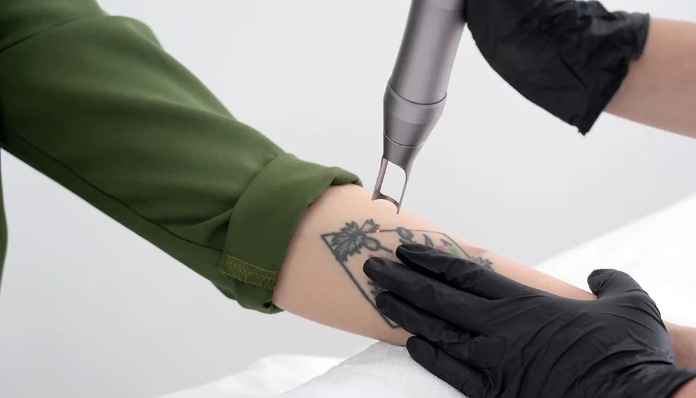 PicoWay Tattoo Removal treatment